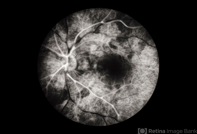 Central Serous Chorioretinopathy: Management strategies