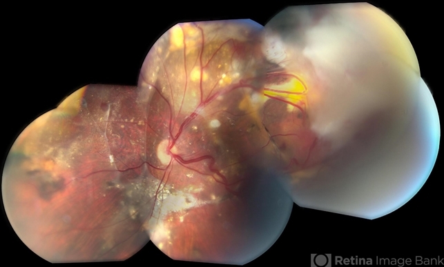 Von Hippel-Lindau Syndrome