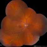 Acute Idiopathic Maculopathy