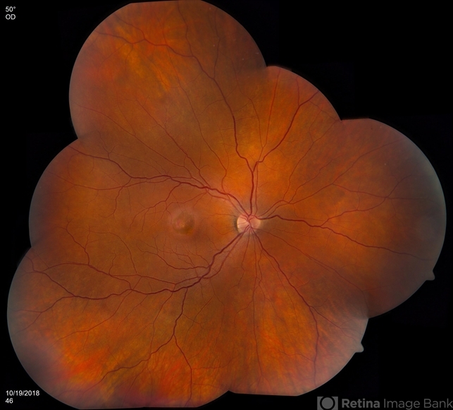 Acute Idiopathic Maculopathy: all you need to know