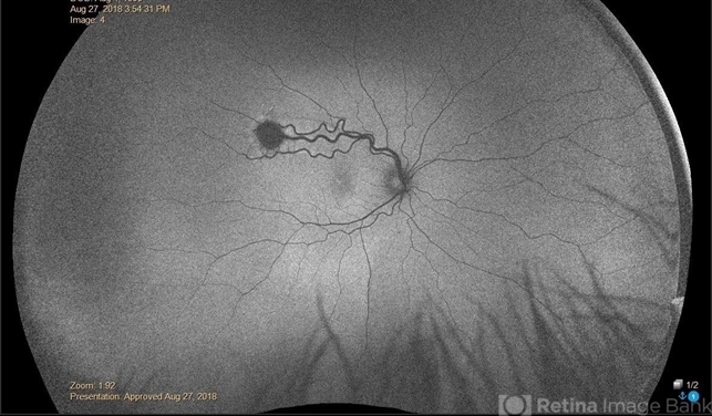 Von Hippel-Lindau Syndrome