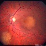 Choroidal Metastases
