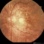 Pentosan Polysulfate Maculopathy