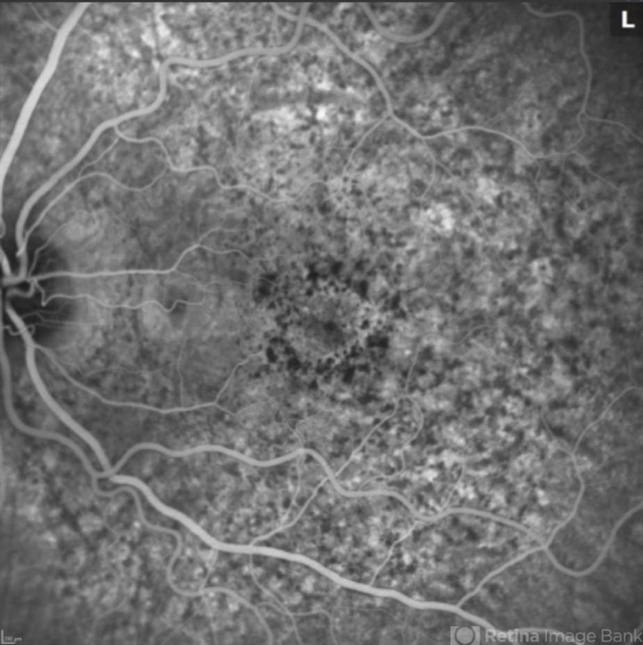 Pentosan Polysulfate Maculopathy