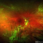 Cytomegalovirus (CMV) Retinitis