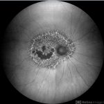 Pentosan Polysulfate Maculopathy
