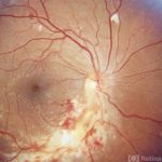 Cytomegalovirus (CMV) Retinitis