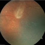 Unilateral Pigmentary Retinopathy