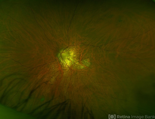 Pentosan Polysulfate Maculopathy
