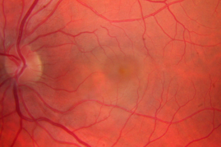 Acute Idiopathic Maculopathy