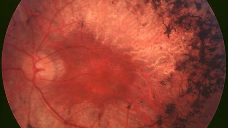 Unilateral Pigmentary Retinopathy