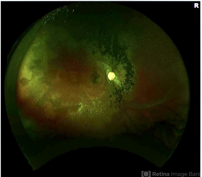 Acute Zonal Occult Outer Retinopathy