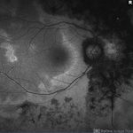 Acute Zonal Occult Outer Retinopathy