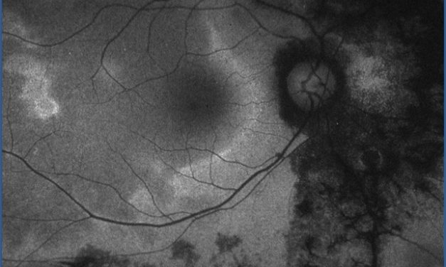 Acute Zonal Occult Outer Retinopathy (AZOOR): a comprehensive article