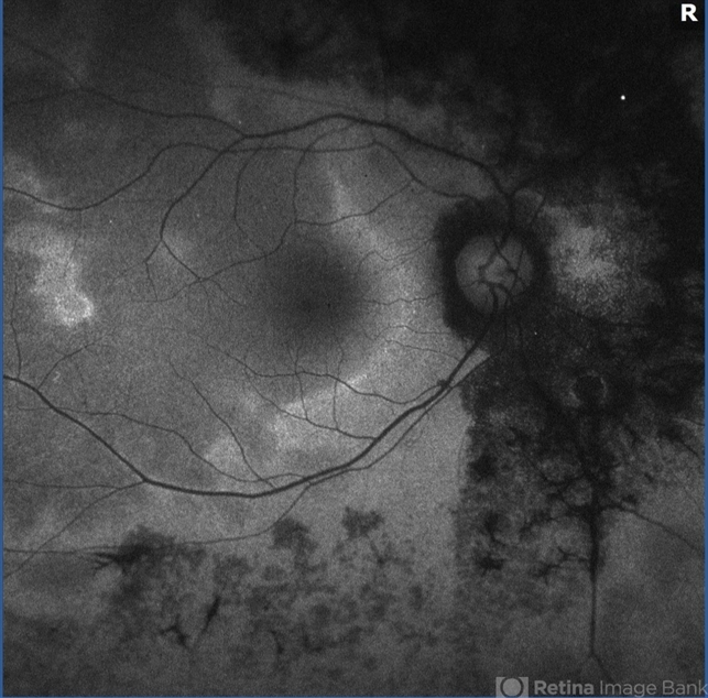 Acute Zonal Occult Outer Retinopathy (AZOOR): a comprehensive article