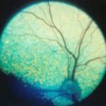 Sudden Acquired Retinal Degeneration
