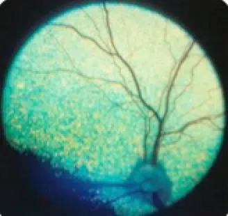 Sudden Acquired Retinal Degeneration (SARD): full study