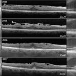 Central Foveal Bouquet Abnormalities