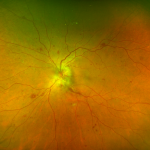 Diabetic Papillopathy