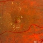 Retinal Angiomatous Proliferation (RAP)