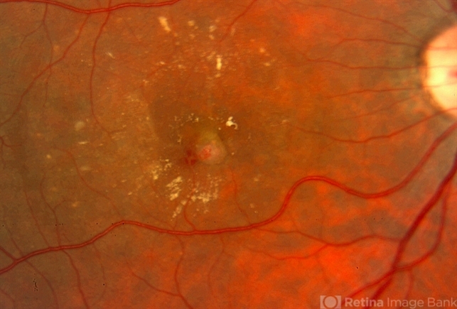 Retinal Angiomatous Proliferation (RAP): What is it ?!