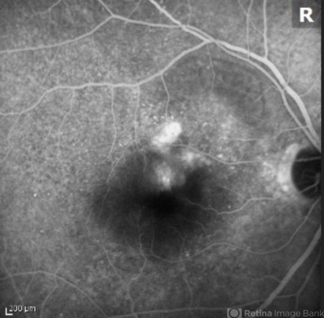 Retinal Angiomatous Proliferation (RAP)