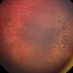 Incontinentia pigmenti