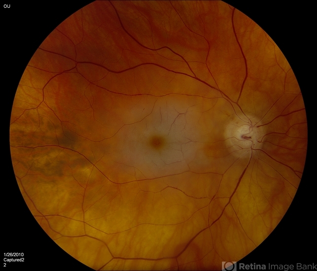 Central retinal artery occlusion