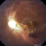 Central retinal artery occlusion