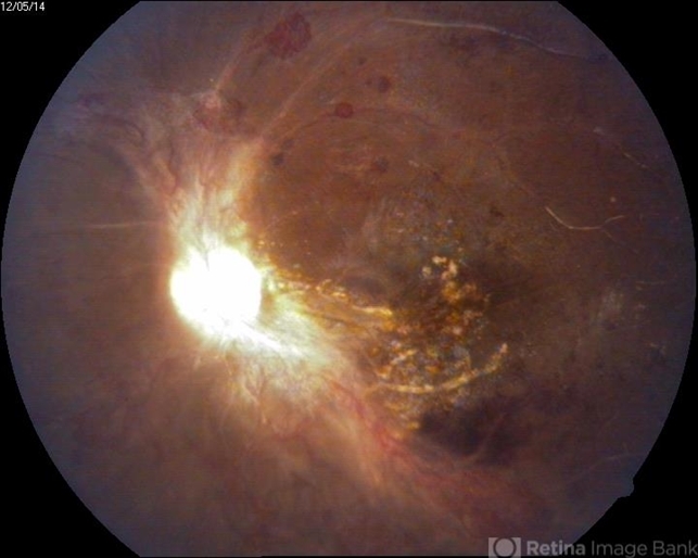 Central retinal artery occlusion: management strategies