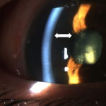 Iris Retraction Syndrome