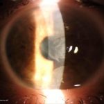 Advancing Wavelike Epitheliopathy