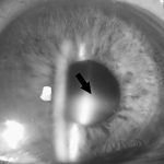 Lens-induced uveitis (LIU)
