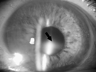Lens-induced uveitis (LIU)