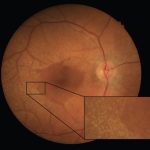 Alport syndrome