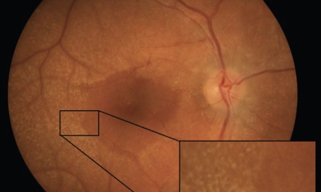 Alport Syndrome: ocular manifestations