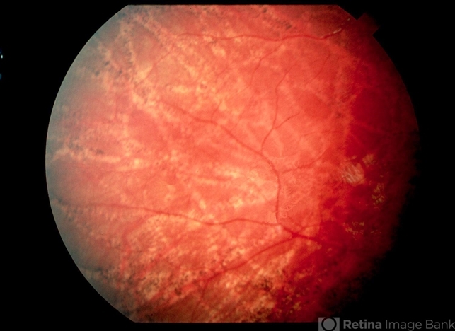 Ophthalmomyiasis