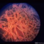 Ophthalmomyiasis