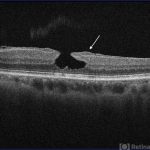 Lamellar Macular Hole