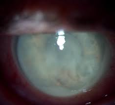 Lens-induced uveitis (LIU)