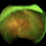 POSTERIOR VITREOUS DETACHMENT (PVD)
