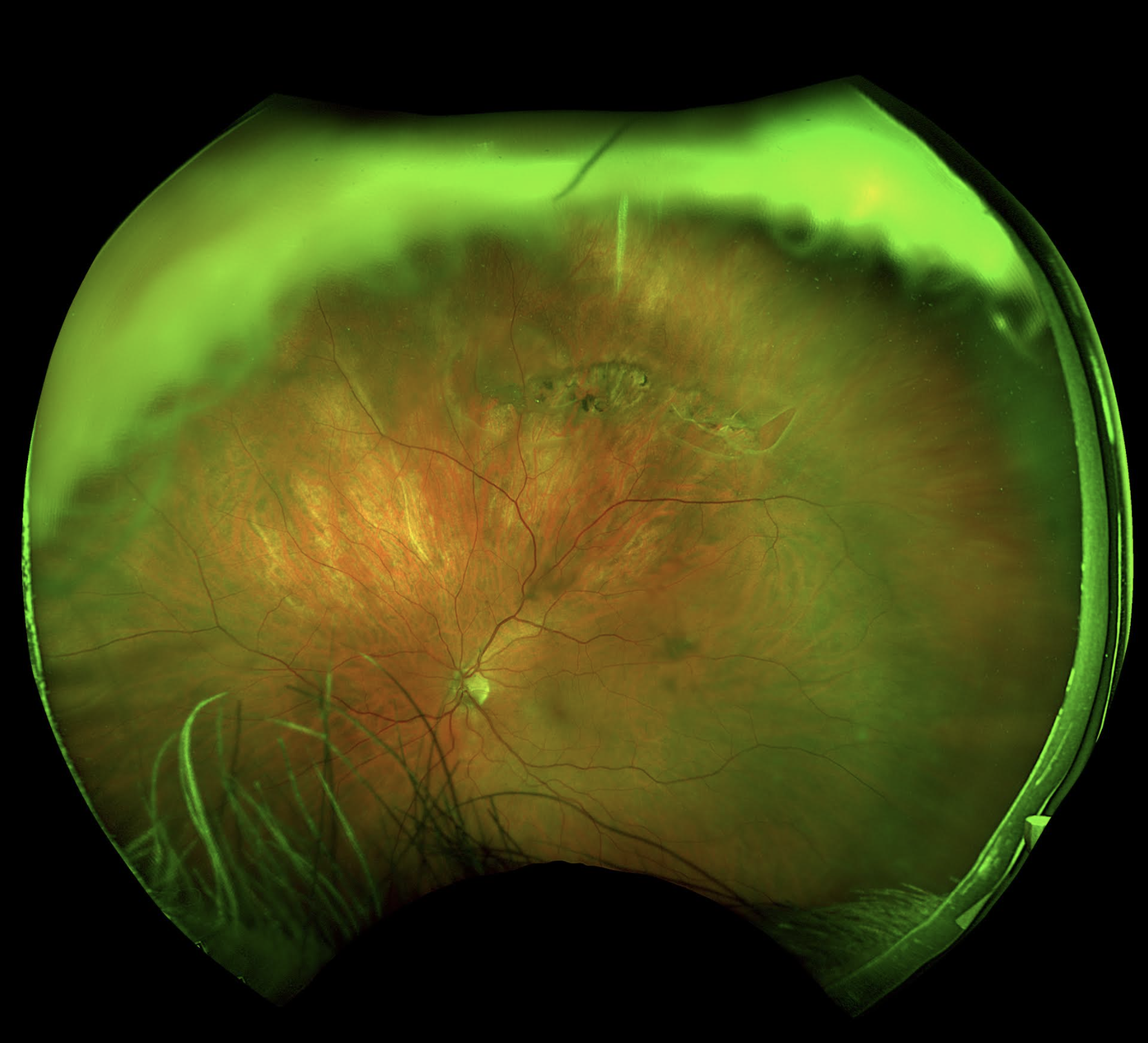 POSTERIOR VITREOUS DETACHMENT (PVD): what is it?!