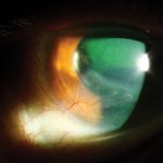 Ocular Graft Versus Host Disease
