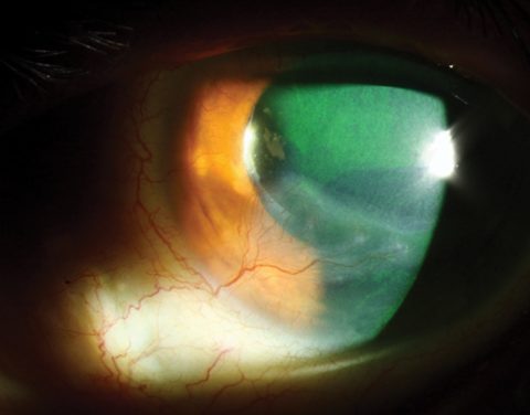 Ocular Graft Versus Host Disease (GVHD): What you need to know!