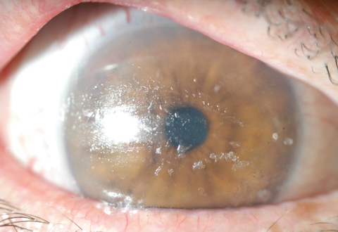 Ocular Graft Versus Host Disease