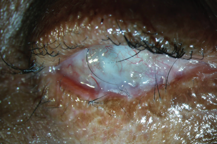 Ocular cicatricial pemphigoid (OCP)