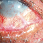 Ocular cicatricial pemphigoid (OCP)