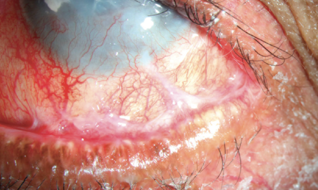 Ocular Cicatricial Pemphigoid (OCP): management strategies