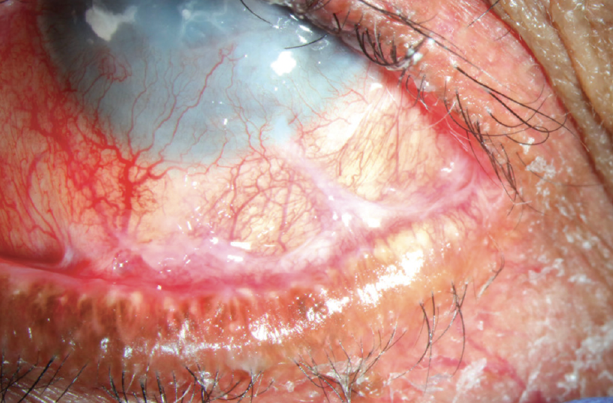 Ocular cicatricial pemphigoid (OCP)