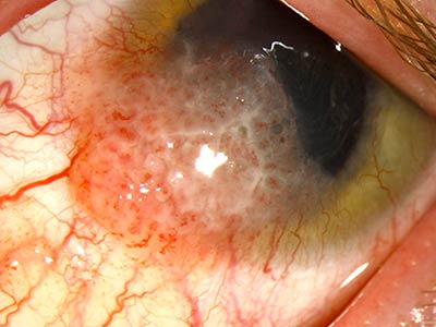 Ocular Surface Squamous Neoplasia (OSSN): A full study